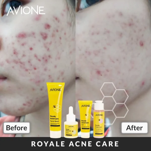 𝐑𝐀𝐃𝐘𝐒𝐀 - Avione Royale Acne Care Serum / Serum Wajah - Image 6